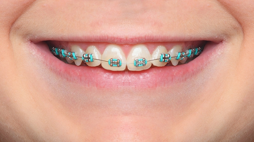 Best Braces near Elgin