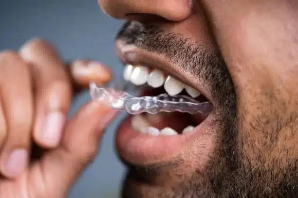 clear aligners for adults