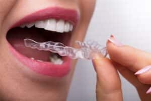 clear aligners for adults