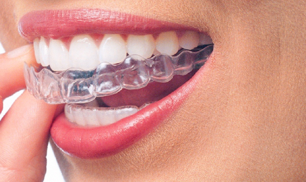 Invisalign Treatment Length: What You Need to Know Prior