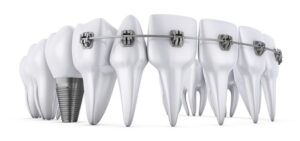 Braces with Implants: Benefits, Process, and Key Considerations