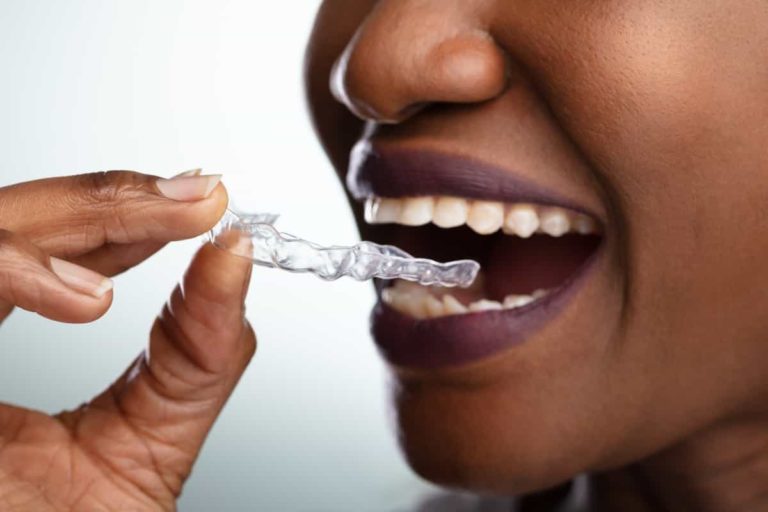 Top Invisalign Tips for Staying on Track and Achieving Ideal Results