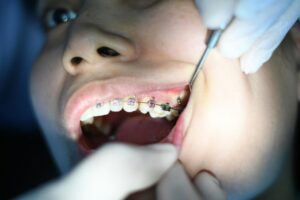 Foods to Avoid With Braces: Essential Tips for Pain-Free Eating