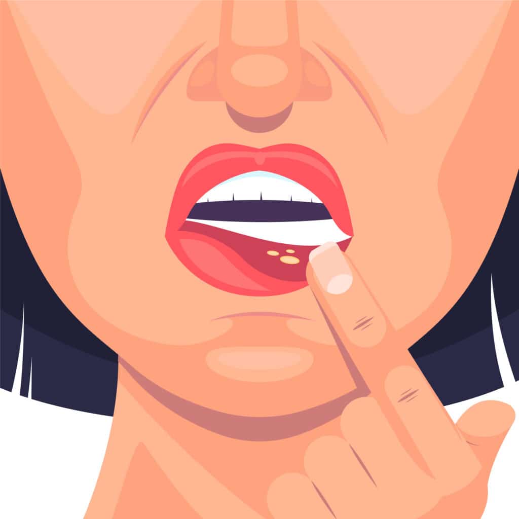 cuts in mouth from braces