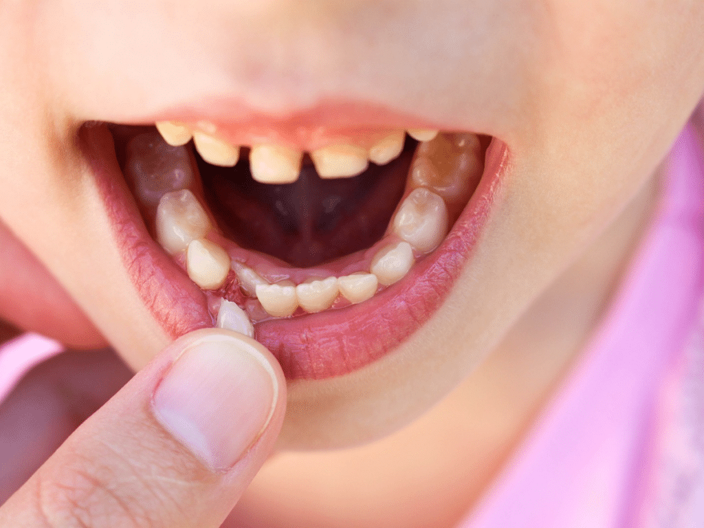 Close-up of a child losing a baby tooth showing baby teeth orthodontic development