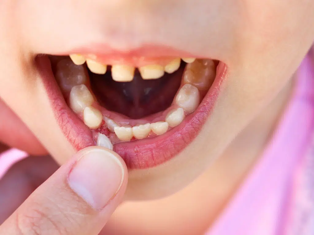 Close-up of a child losing a baby tooth showing baby teeth orthodontic development