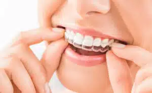 Person placing clear aligners on teeth demonstrating Invisalign cleaning tips