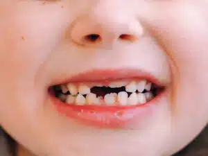 Close-up of a child’s smile showing spacing issues addressed through orthodontics for kids