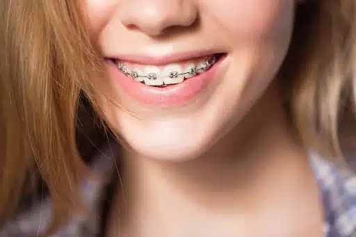 Close-up smile showing braces, illustrating a healthy teen braces lifestyle during orthodontic treatment