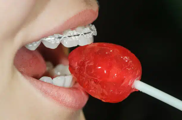 Close-up photo of teen with braces licking hard candy