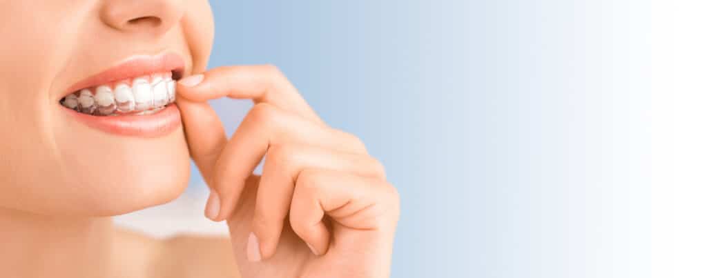 Patient wearing Invisalign aligners after refinement scan