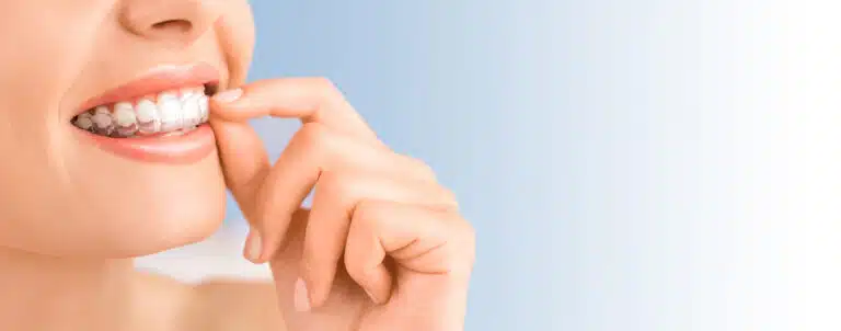 Patient wearing Invisalign aligners after refinement scan