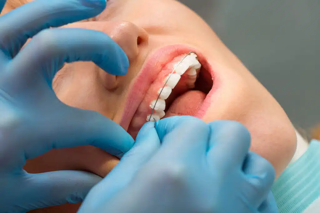 Teen receiving braces near Lake Murray of Richland, SC
